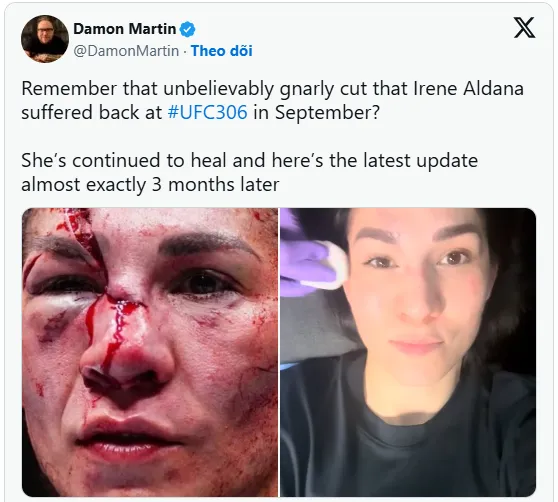 image_67501bc225574 Irene Aldana’s miraculous recovery from UFC 306 facial injuries